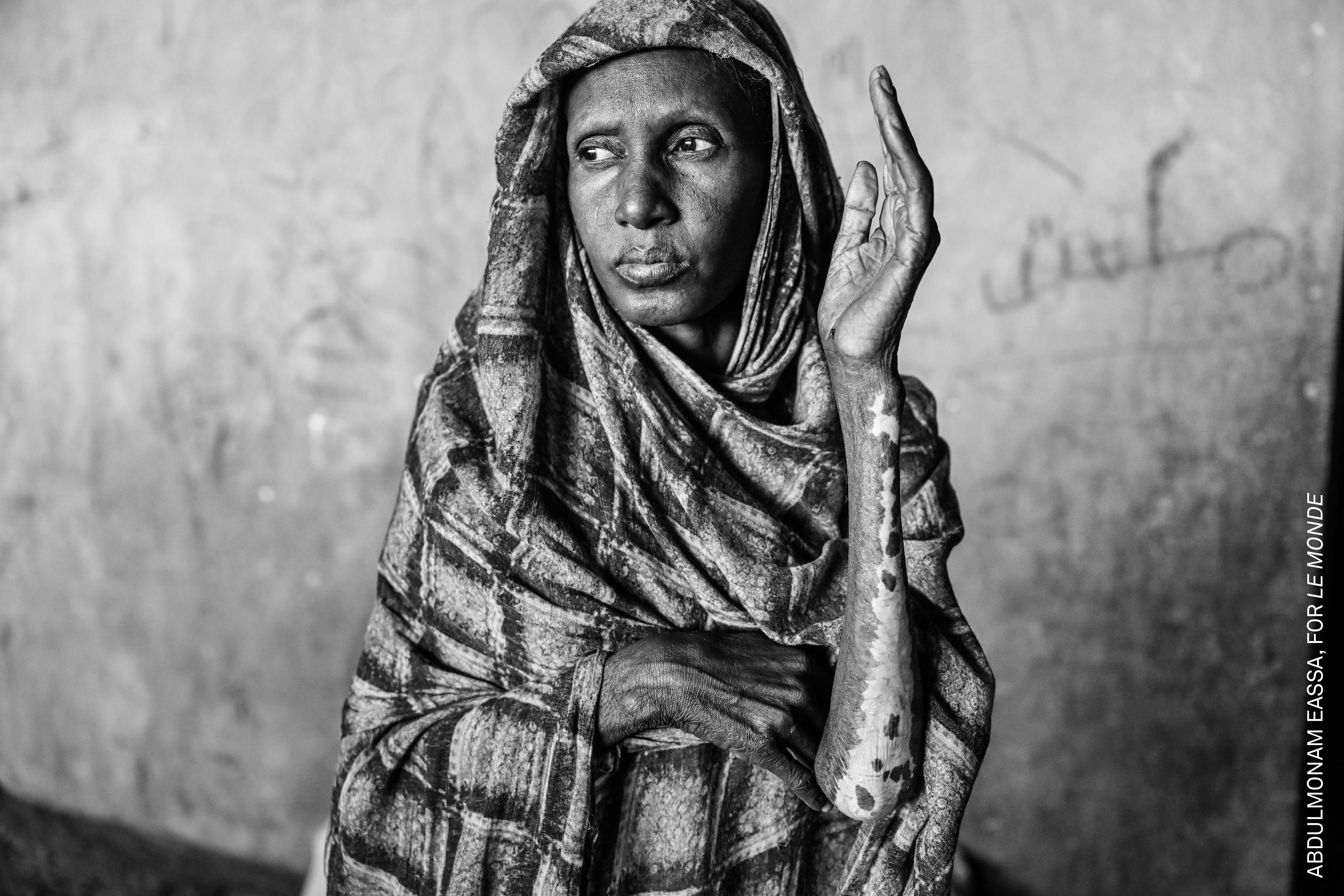Alhaja Abdallah, a displaced woman from Bara, shows her scars from a fire at Al-Mohad camp in El-Obeid, Sudan. The RSF Paramilitary forces have set multiple displacement camps ablaze.