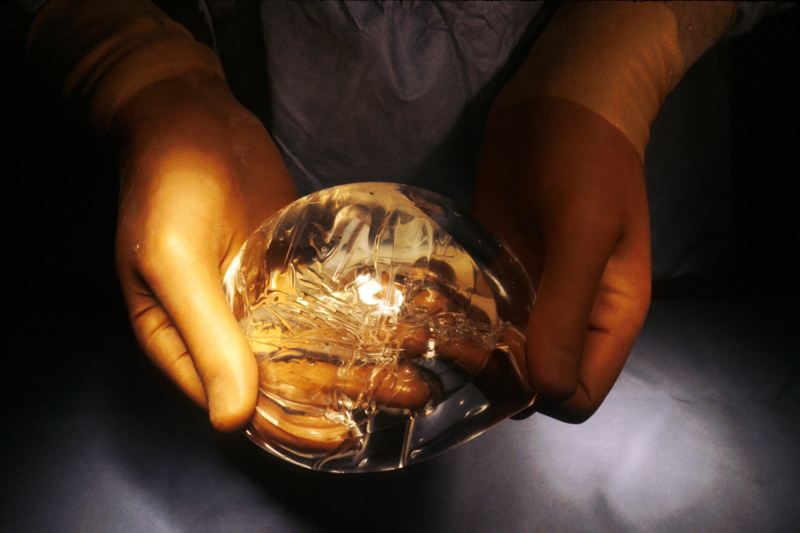 Hand holding silicone breast implant