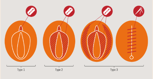 This image provides a visual description of the different types of FGM.